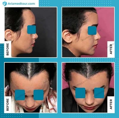 forehead contouring before and after photo