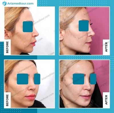 forehead contouring in Iran before after