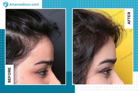 forehead contouring before and after photo in Iran