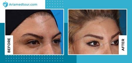 forehead contouring in Iran before and after photo