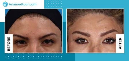 forehead contouring in Iran before after photo