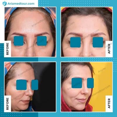 forehead contouring before and after photo in Iran