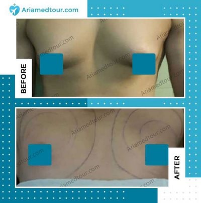 gynecomastia surgery before and after photo in iran