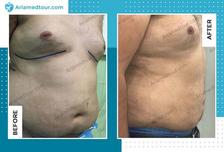gynecomastia before and after photo
