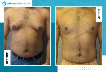 male breast reduction surgery before and after