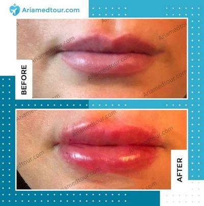 lip augmentation before and after photo