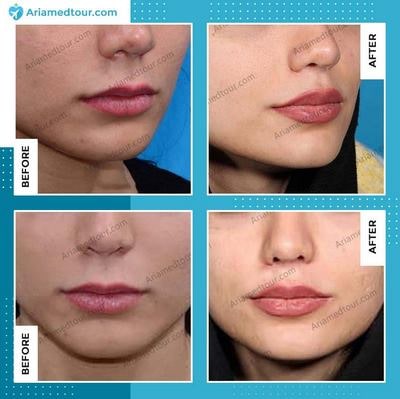 lip augmentation before and after photo
