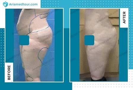 thigh lift before and after photo in Iran