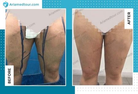 thigh lift before and after photo