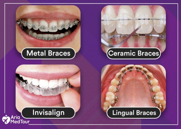 Invisalign vs. Braces Which Is Best for You? AriaMedTour