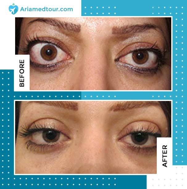 a woman's eyes after bulging eyes treatment