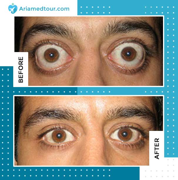 a man's eyes after protruding eye treatment