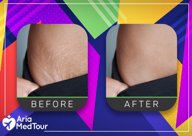a photo showing before after stretch mark treatment