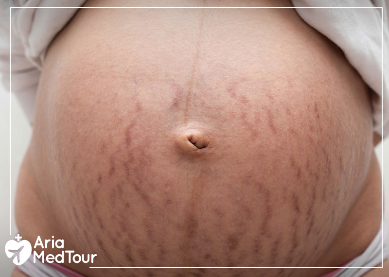 the abdomen of a pregnant woman with stretch marks on its skin