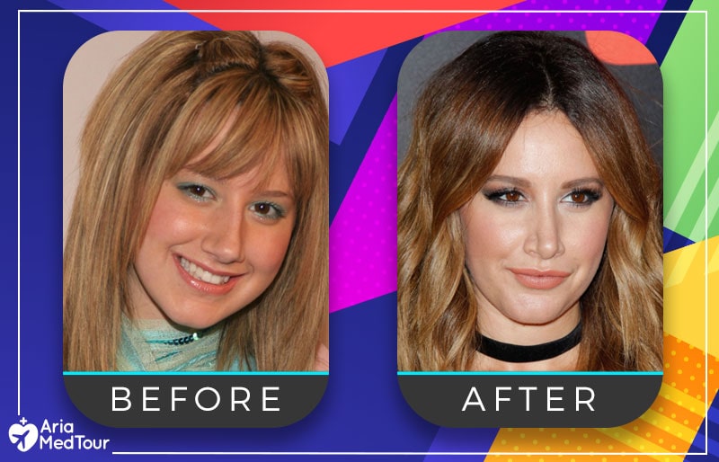 Ashley Tisdale nose job before after photo