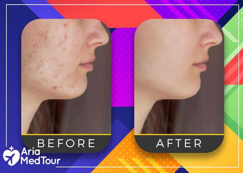 before and after photo of acne treatment