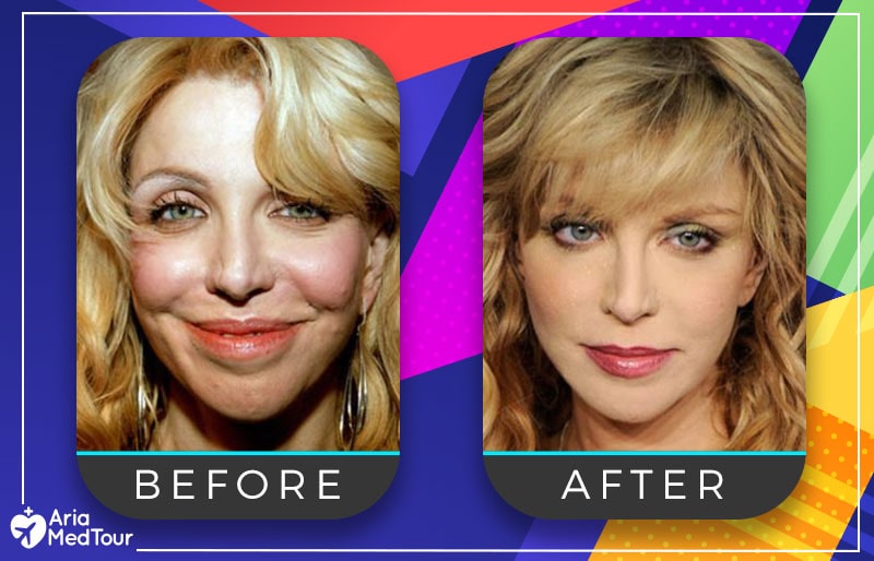 Courtney Love nose job before after photo