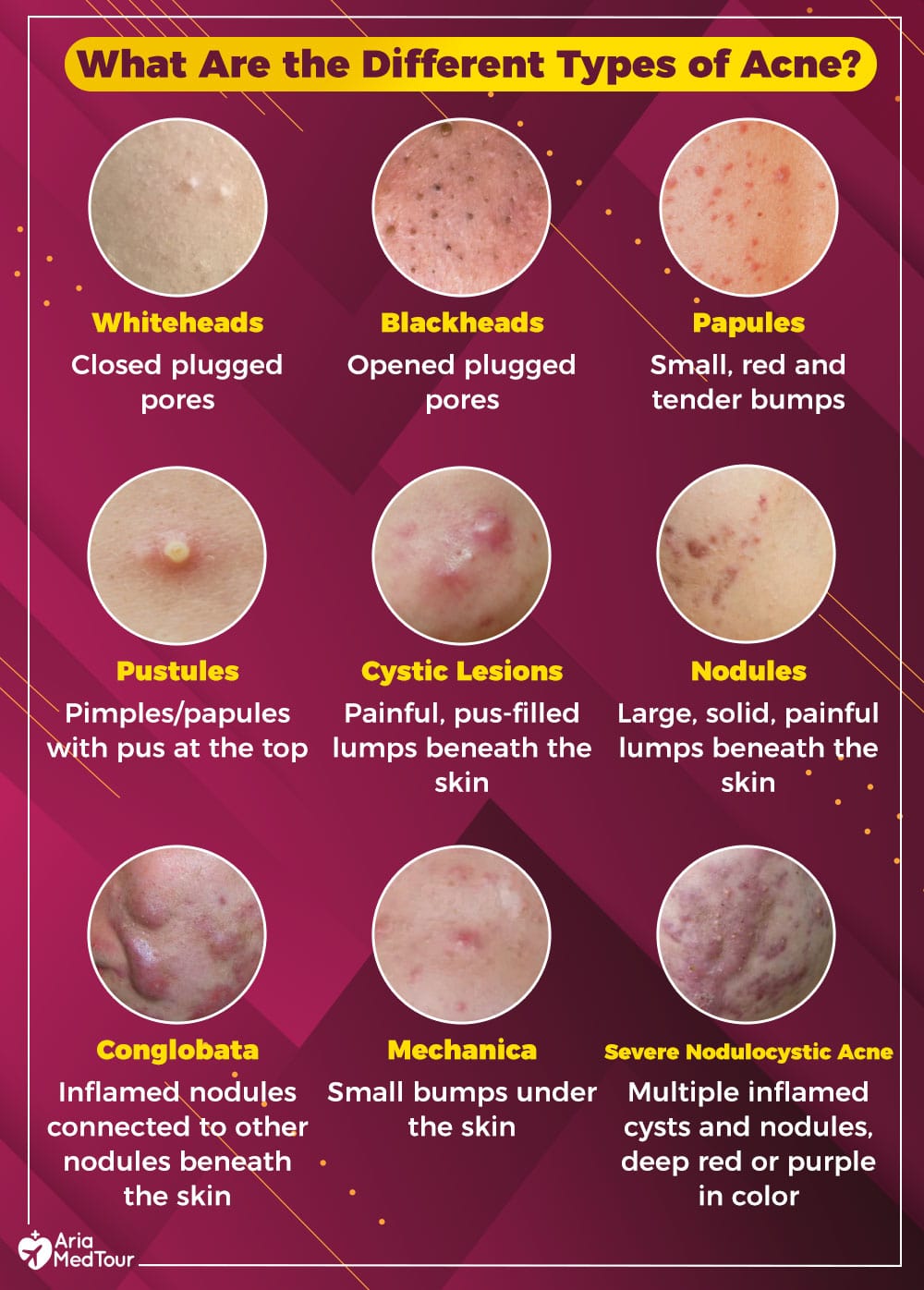 Types of acne: what are the different types of acne?