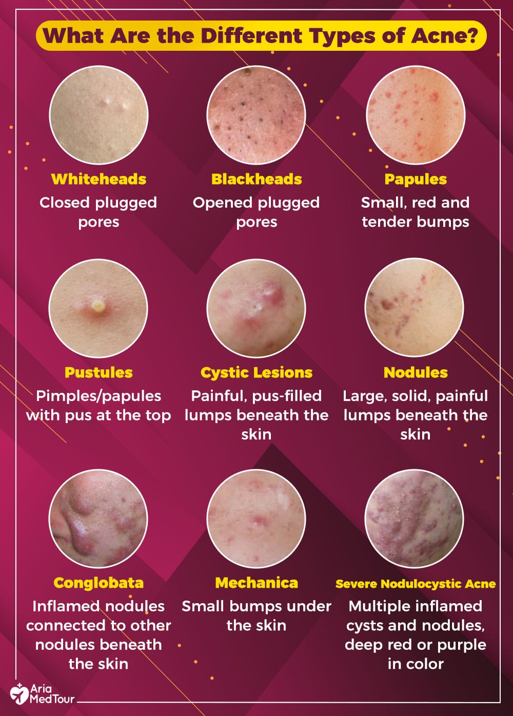 Different types on sale of acne