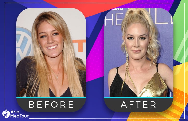 Heidi Montag nose job before after photo