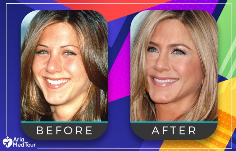 21 Celebrity Nose Jobs Before And After Transformations UWNF