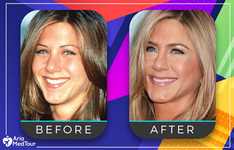 Jennifer Aniston nose job before after photo