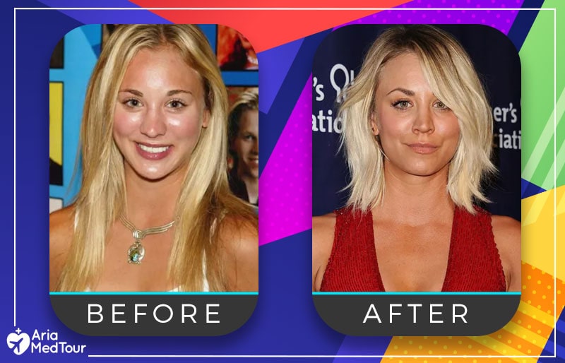 Kaley Cuoco nose job before after photo