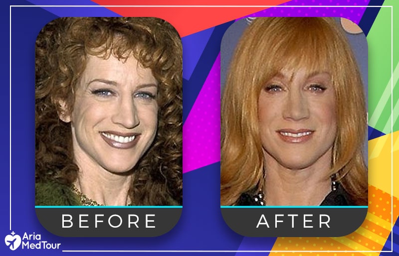 Kathy Griffin nose job before after photo