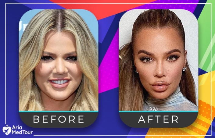 khloe before and after nose job Image 7