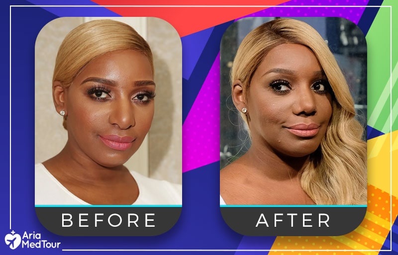 NeNe Leakes nose job before after photo