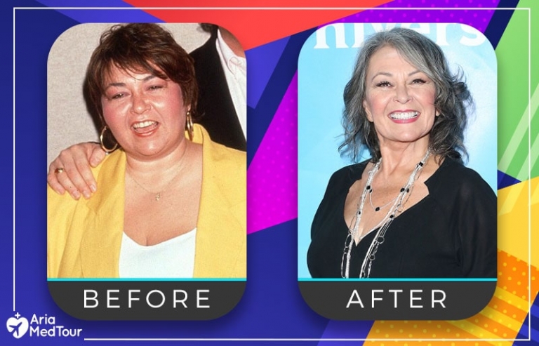 roseanne barr plastic surgery Image 5