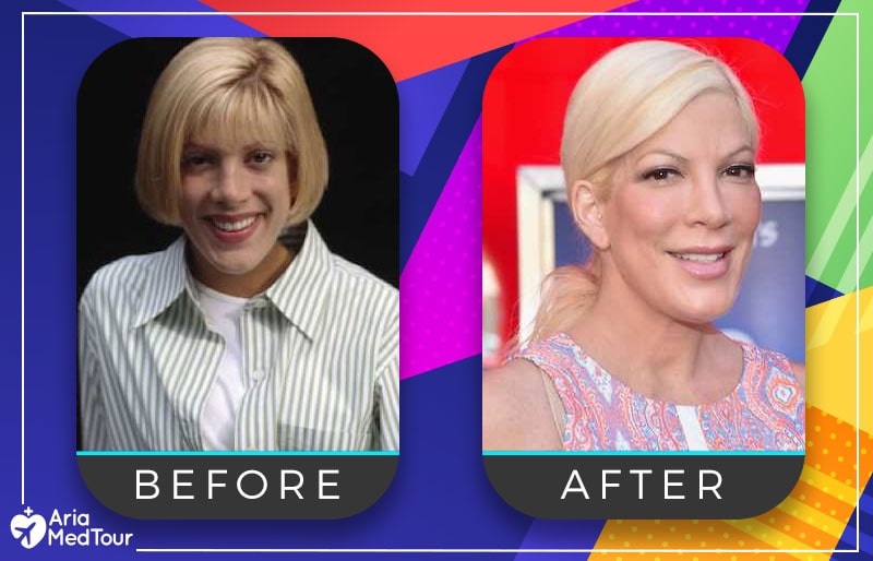 Tori Spelling nose job before after photo