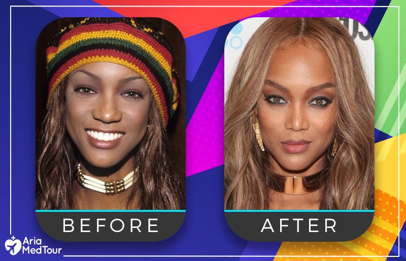 Tyra Banks nose job before after photo