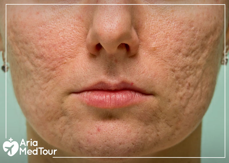 what is acne: a woman with acne on her face