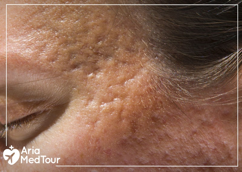 acne on an old woman's face