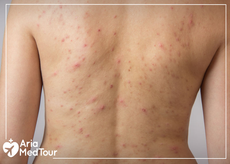 A picture of the back of a woman with pimples and acne on her skin