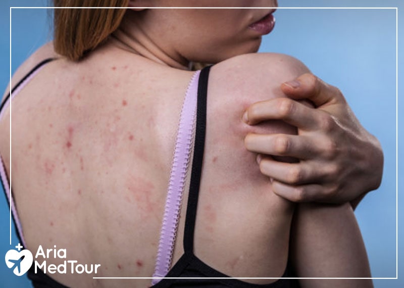 Picture of the back of a young woman with acne and pimples on her skin