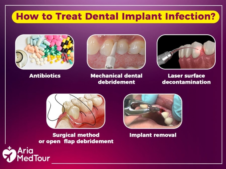 Dental Implant Infection Causes, Prevention and Treatments