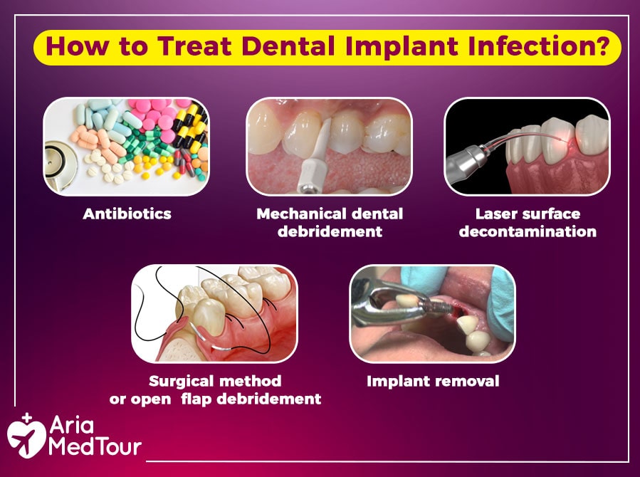 dental implant infection treatment: how to treat dental implants infection?