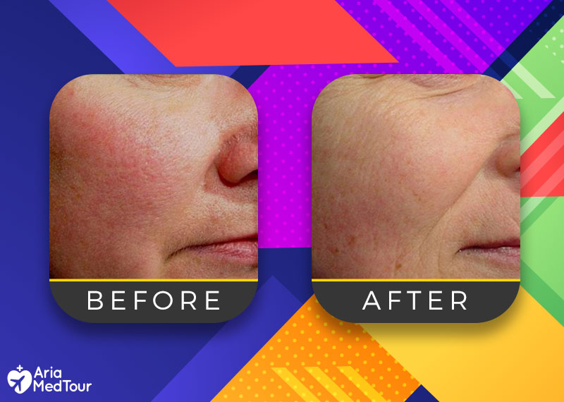 facial skin of a woman before and after laser genesis