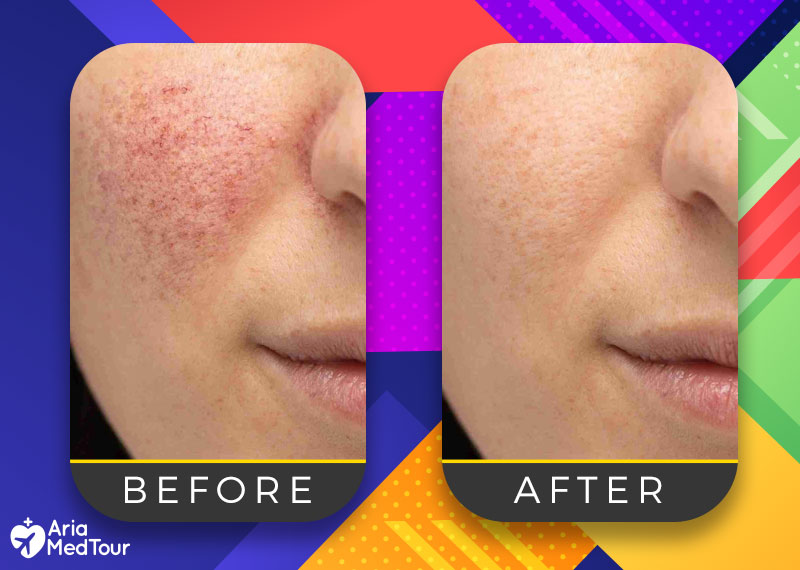 a woman's facial skin before and after a laser genesis