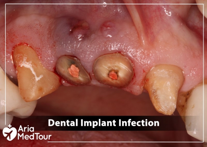 dental-implant-infection-causes-prevention-and-treatments