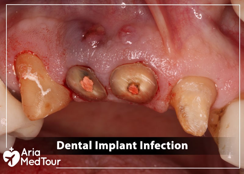 an infected dental implants