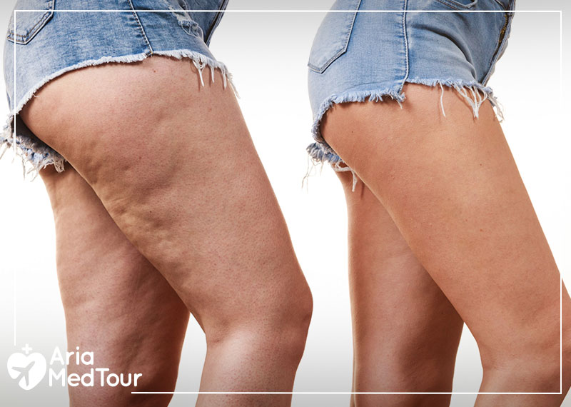 a woman's fat thigh before and after cellulite treatment