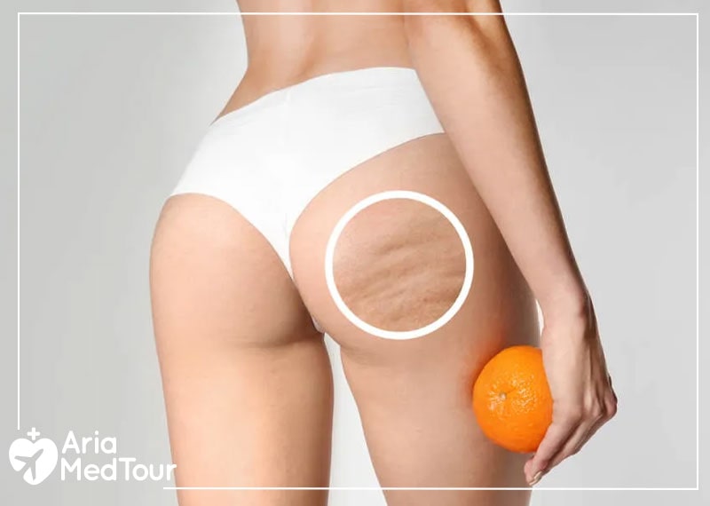 signs of cellulite on a woman's buttocks