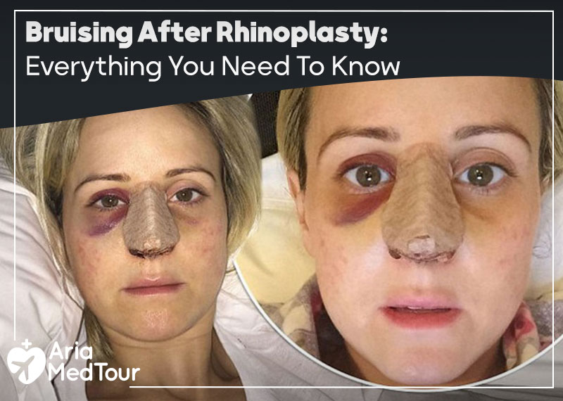 Everything You Need To Know About Bruising After Rhinoplasty