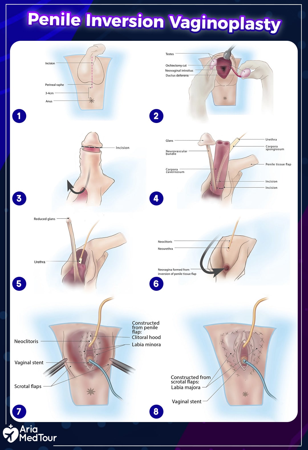 An unrealistic image of the procedure of Penile Inversion Vaginoplasty