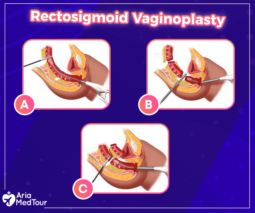 Colon graft vaginoplasty & Rectosigmoid vaginoplasty