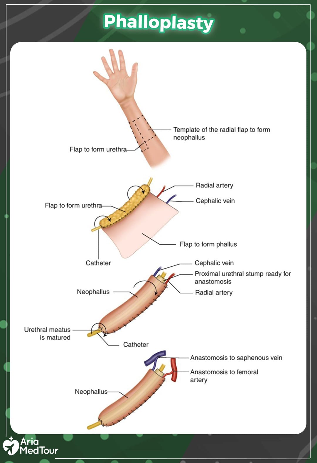 an infographic image showing Phalloplasty