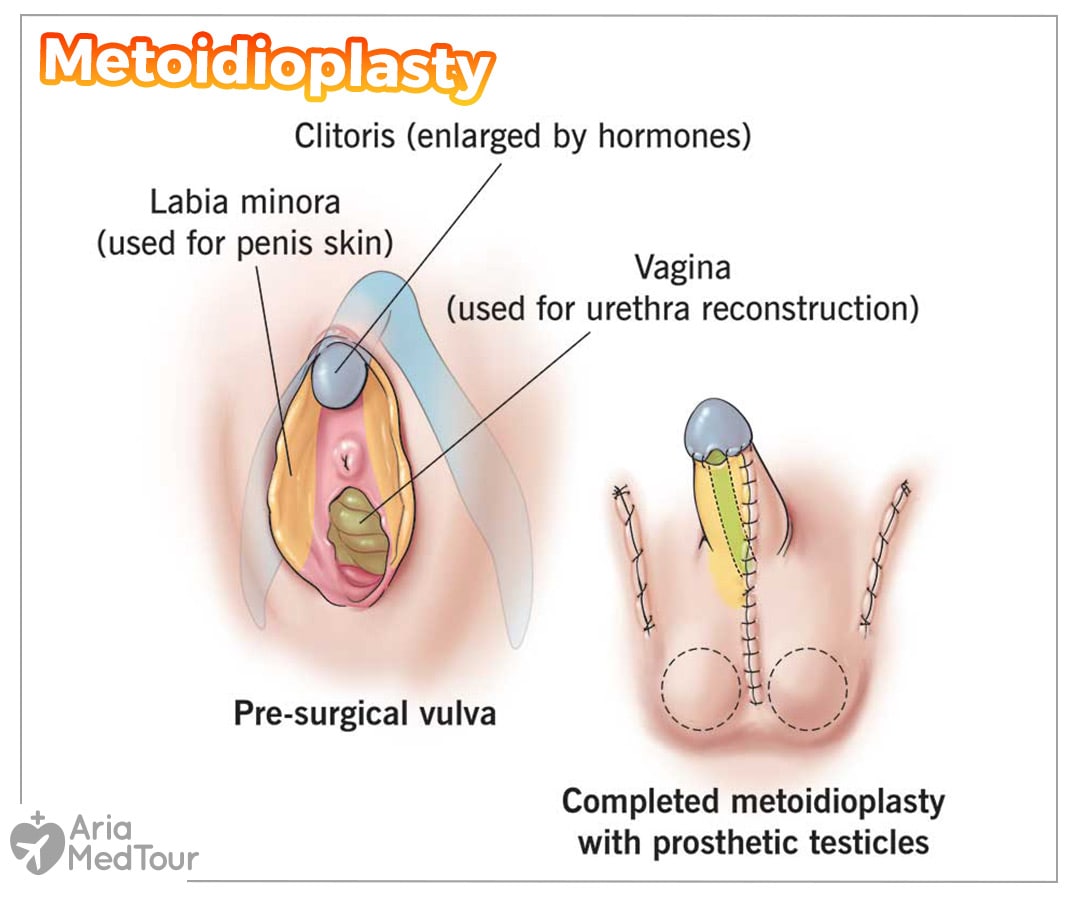 an infographic image showing Metoidioplasty